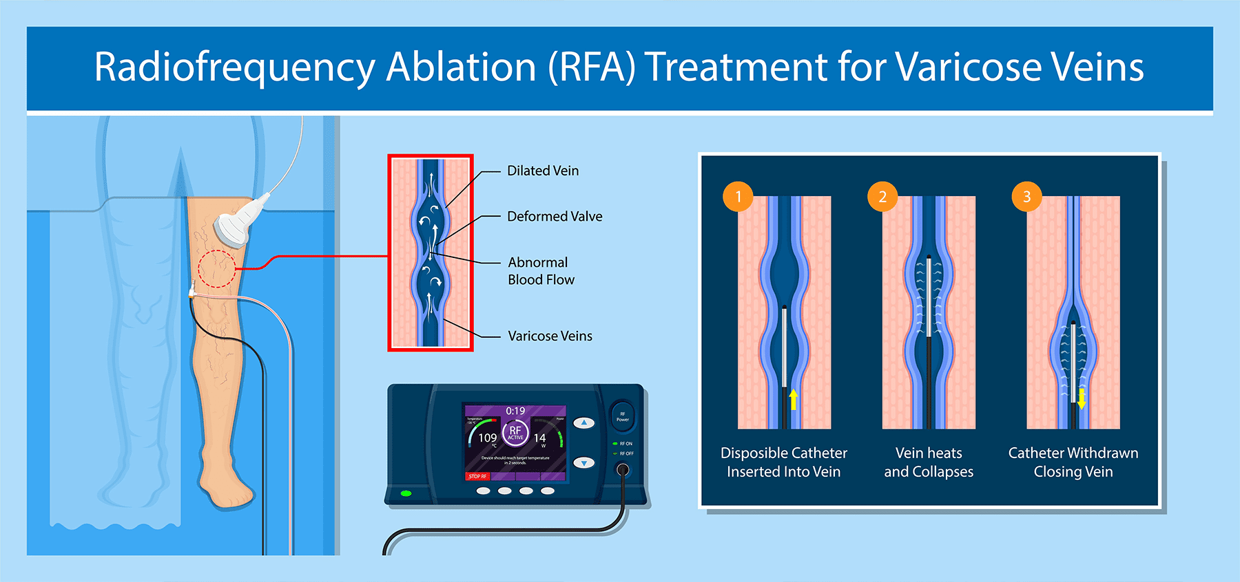 Vein Doctor, Radiofrequency Ablation