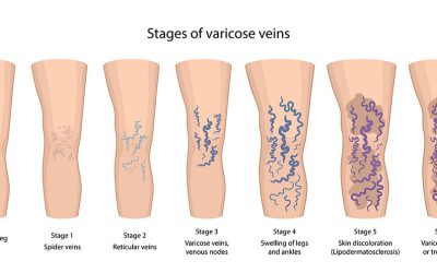 Which Professions are at risk for vein disease