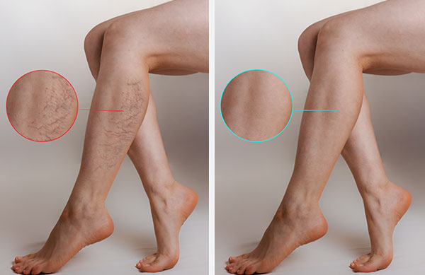 Varicose vein before and after